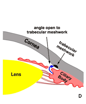 Open angle following laser iridotomy 